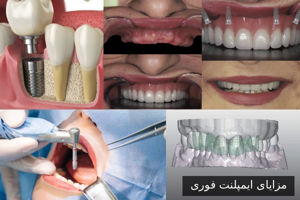 مزایای ایمپلنت فوری