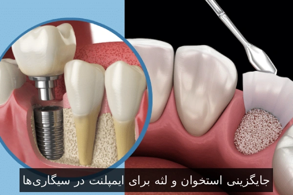 جایگزینی استخوان و لثه برای ایمپلنت در سیگاری‌ها