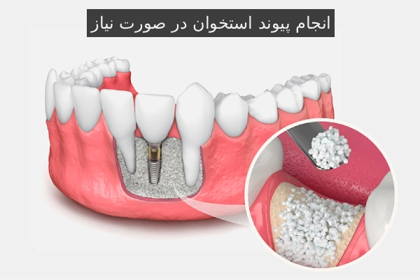 انجام پیوند استخوان در صورت نیاز