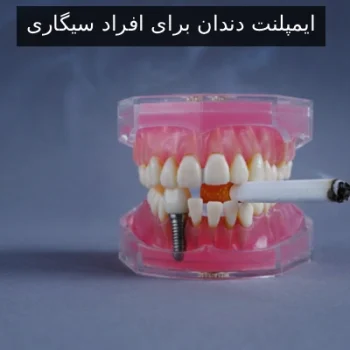 ایمپلنت دندان برای افراد سیگاری