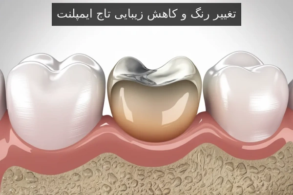 تغییر رنگ و کاهش زیبایی تاج ایمپلنت