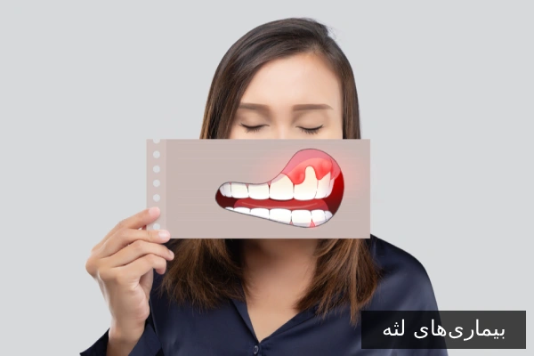 بیماری‌های لثه
