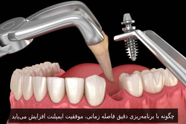 چگونه با برنامه‌ریزی دقیق فاصله زمانی، موفقیت ایمپلنت افزایش می‌یابد