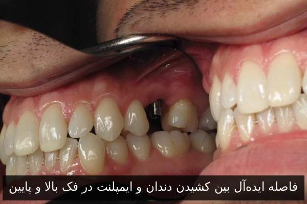 فاصله ایده‌آل بین کشیدن دندان و ایمپلنت در فک بالا و پایین