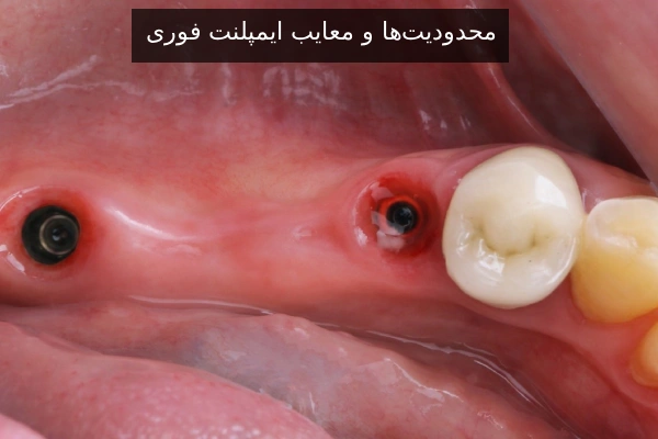 محدودیت‌ها و معایب ایمپلنت فوری