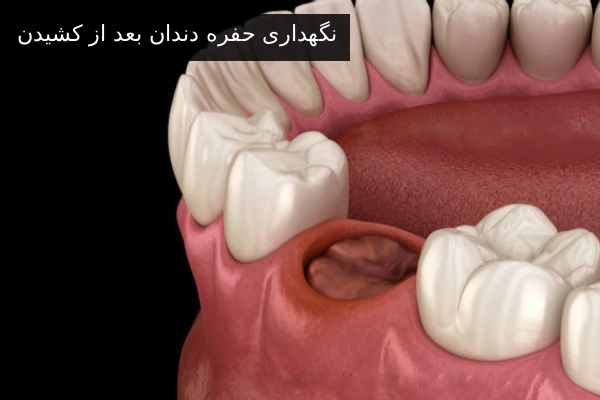 نگهداری حفره دندان بعد از کشیدن