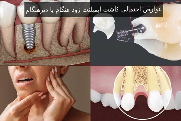 عوارض احتمالی کاشت ایمپلنت زود هنگام یا دیرهنگام
