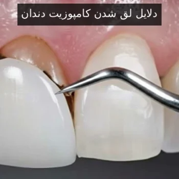 دلایل لق شدن کامپوزیت دندان