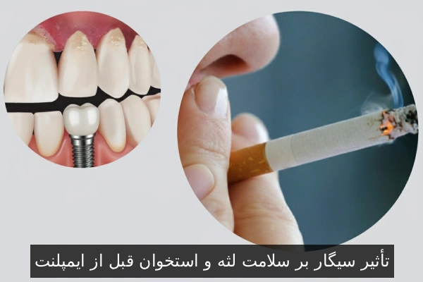 تأثیر سیگار بر سلامت لثه و استخوان قبل از ایمپلنت