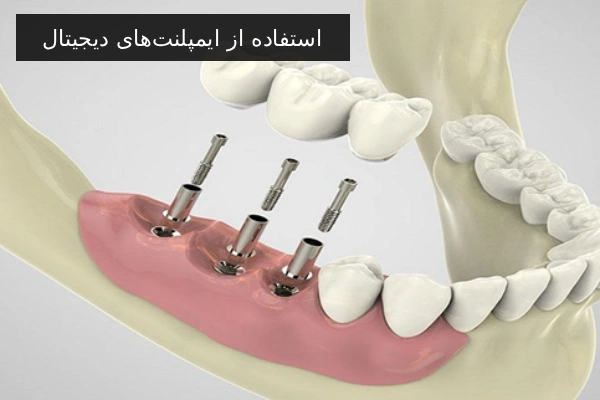 استفاده از ایمپلنت‌های دیجیتال