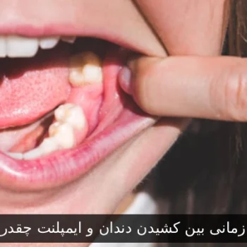 فاصله زمانی بین کشیدن دندان و ایمپلنت چقدر است؟