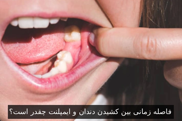 فاصله زمانی بین کشیدن دندان و ایمپلنت چقدر است؟