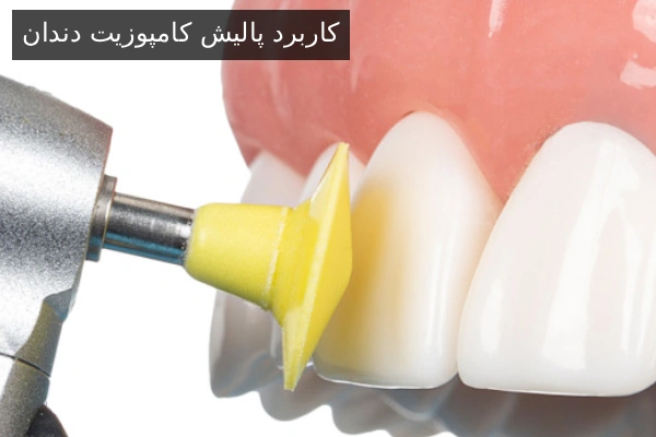 کاربرد پالیش کامپوزیت دندان