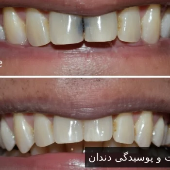 کامپوزیت و پوسیدگی دندان