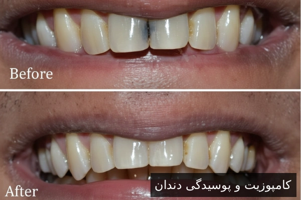 کامپوزیت و پوسیدگی دندان
