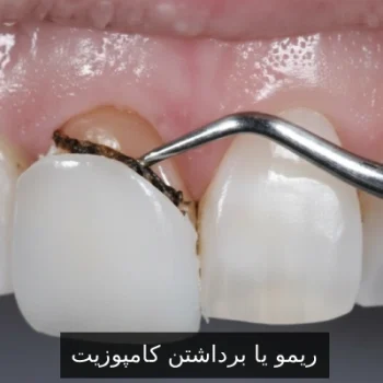 ریمو یا برداشتن کامپوزیت