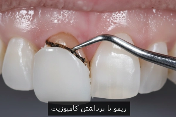 ریمو یا برداشتن کامپوزیت