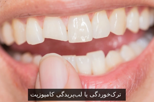 ترک‌خوردگی یا لب‌پریدگی کامپوزیت