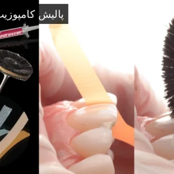 پالیش کامپوزیت دندان
