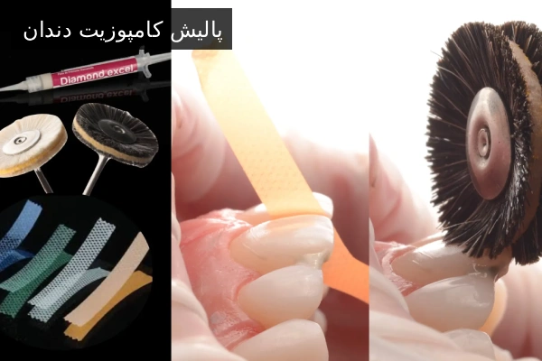 پالیش کامپوزیت دندان