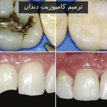 ترمیم کامپوزیت دندان