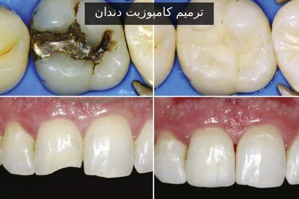 ترمیم کامپوزیت دندان