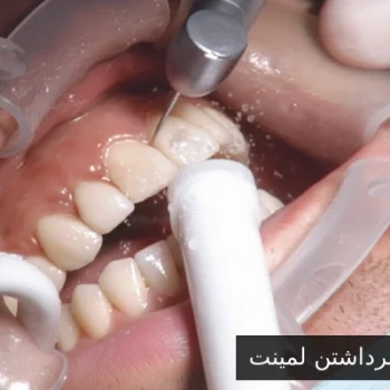 ریمو یا برداشتن لمینت