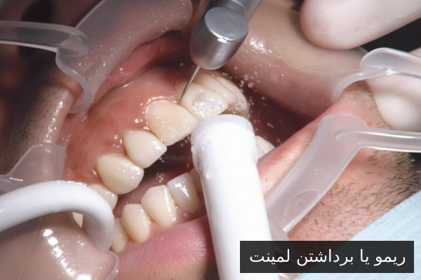 ریمو یا برداشتن لمینت