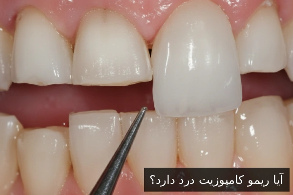 آیا ریمو کامپوزیت درد دارد؟