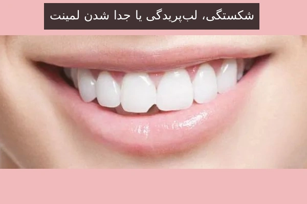 شکستگی، لب‌پریدگی یا جدا شدن لمینت