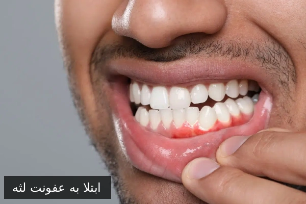 ابتلا به عفونت لثه