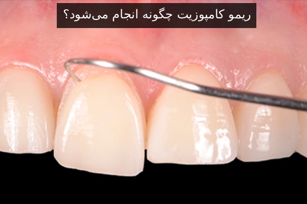 ریمو کامپوزیت چگونه انجام می‌شود؟