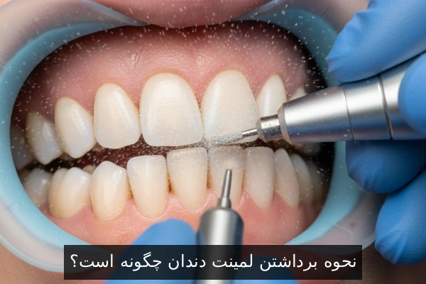 نحوه برداشتن لمینت دندان چگونه است؟