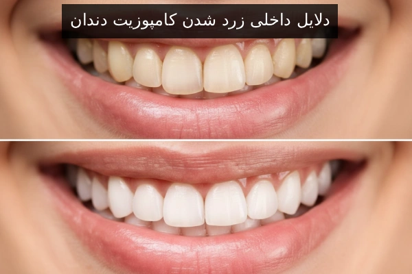 دلایل داخلی زرد شدن کامپوزیت دندان