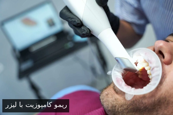 ریمو کامپوزیت با لیزر