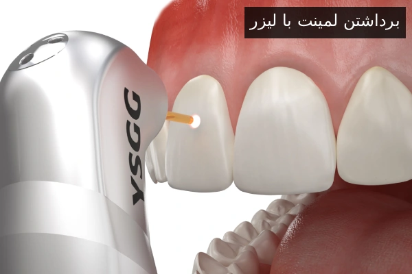 برداشتن لمینت با لیزر