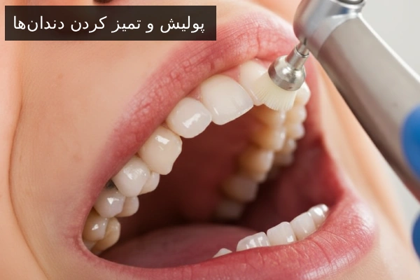 پولیش و تمیز کردن دندان‌ها