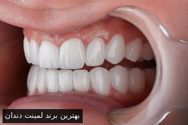 بهترین برند لمینت دندان