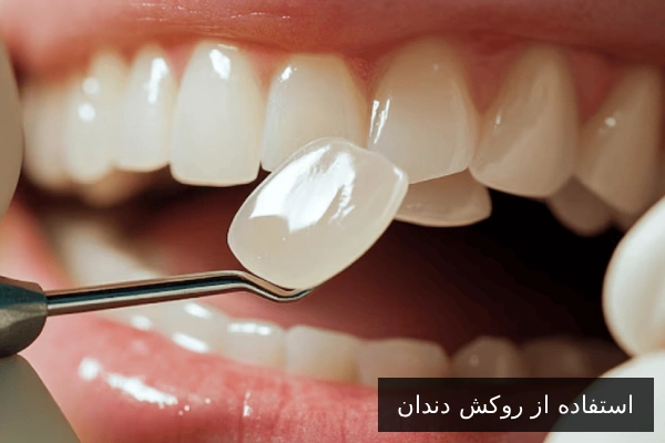 استفاده از روکش دندان