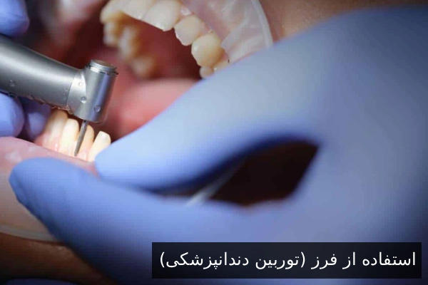 استفاده از فرز (توربین دندانپزشکی)
