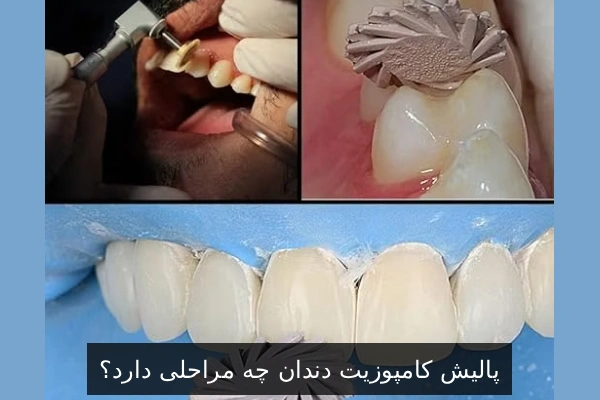 پالیش کامپوزیت دندان چه مراحلی دارد؟