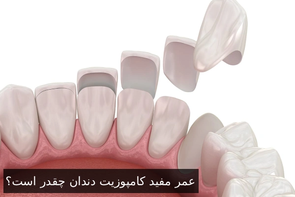 عمر مفید کامپوزیت دندان چقدر است؟