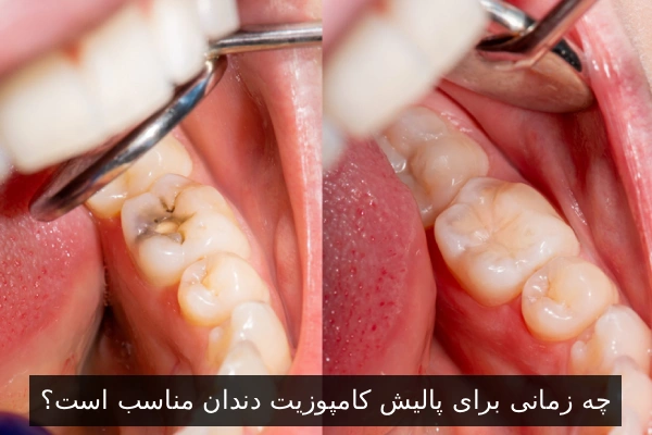 چه زمانی برای پالیش کامپوزیت دندان مناسب است؟