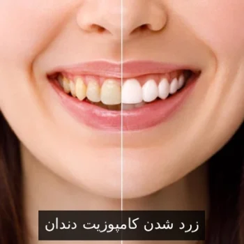 زرد شدن کامپوزیت دندان