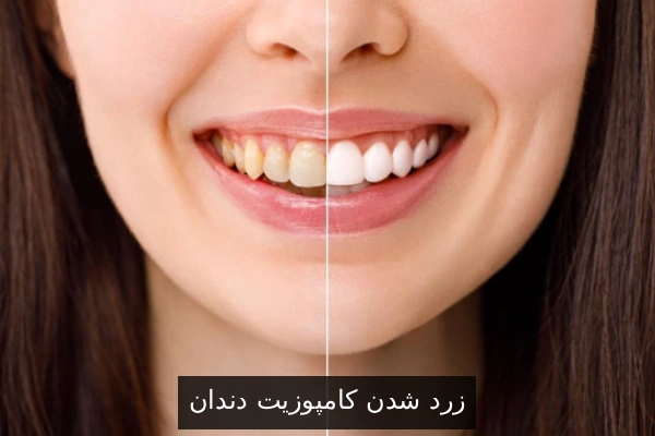 زرد شدن کامپوزیت دندان